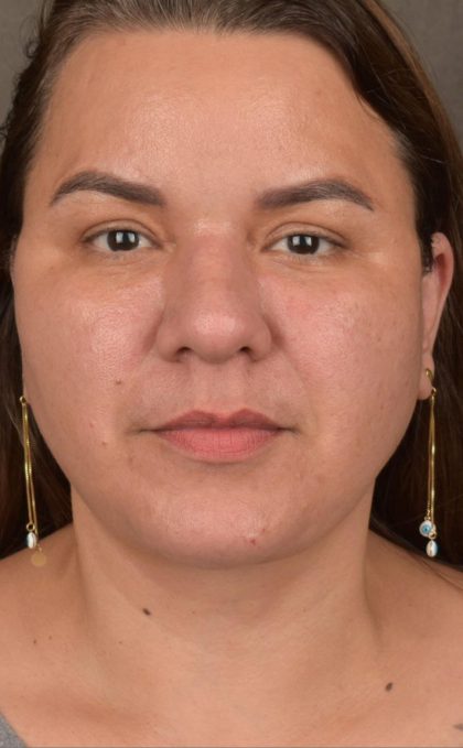 Facelift Before & After Patient #2887