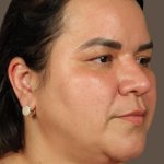 Facelift Before & After Patient #2887