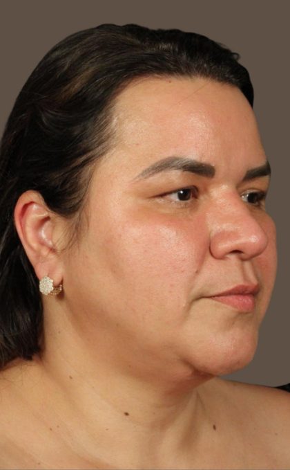 Facelift Before & After Patient #2887