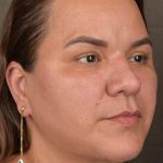 Facelift Before & After Patient #2887