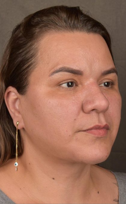 Facelift Before & After Patient #2887