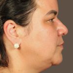 Facelift Before & After Patient #2887
