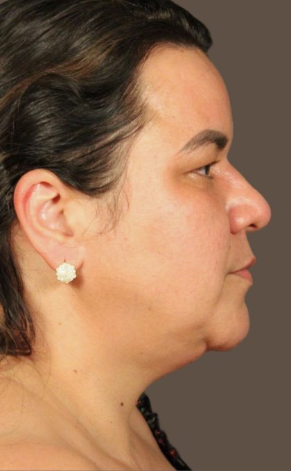 Facelift Before & After Patient #2887