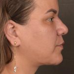 Facelift Before & After Patient #2887