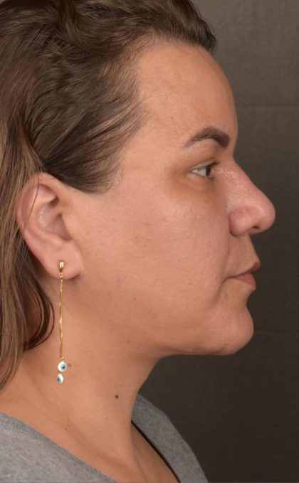 Facelift Before & After Patient #2887