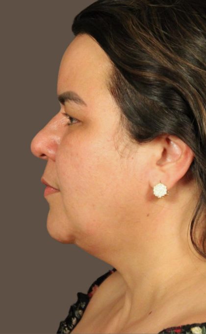 Facelift Before & After Patient #2887
