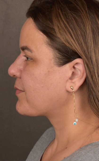 Facelift Before & After Patient #2887