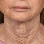 Facelift Before & After Patient #2889