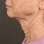 Facelift Before & After Patient #2889