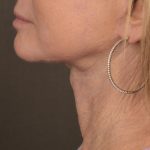 Facelift Before & After Patient #2889