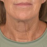 Facelift Before & After Patient #2890