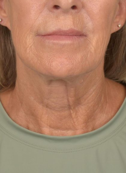 Facelift Before & After Patient #2890