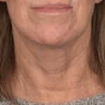 Facelift Before & After Patient #2890