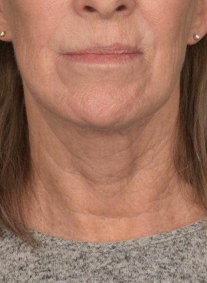 Facelift Before & After Patient #2890