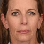 Facelift Before & After Patient #2868