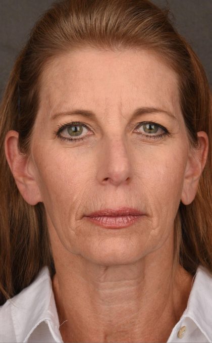 Facelift Before & After Patient #2868