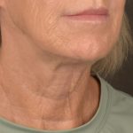 Facelift Before & After Patient #2890