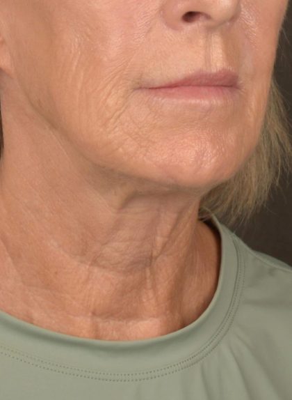 Facelift Before & After Patient #2890