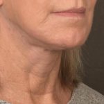 Facelift Before & After Patient #2890
