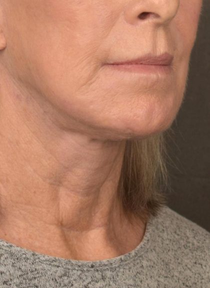 Facelift Before & After Patient #2890