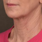 Facelift Before & After Patient #2891