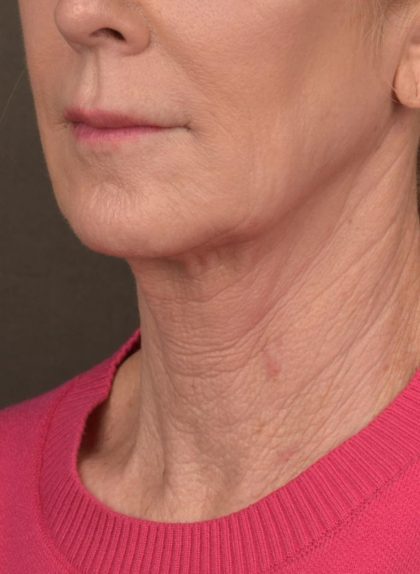 Facelift Before & After Patient #2891