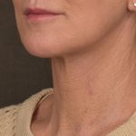 Facelift Before & After Patient #2891