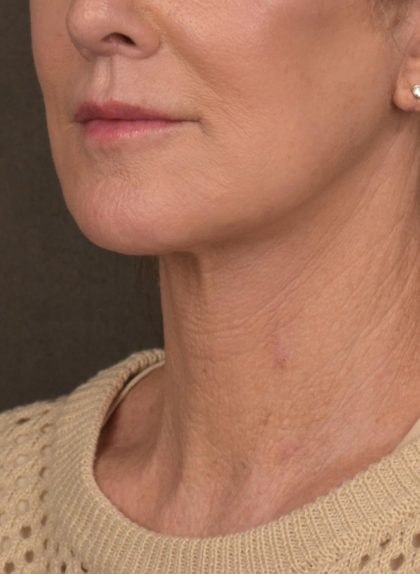 Facelift Before & After Patient #2891