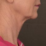 Facelift Before & After Patient #2891