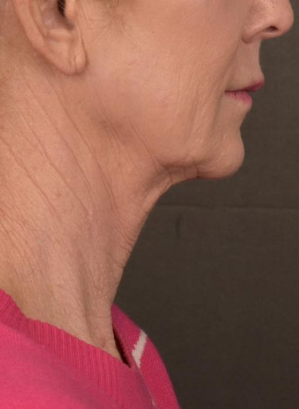 Facelift Before & After Patient #2891