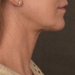 Facelift Before & After Patient #2891