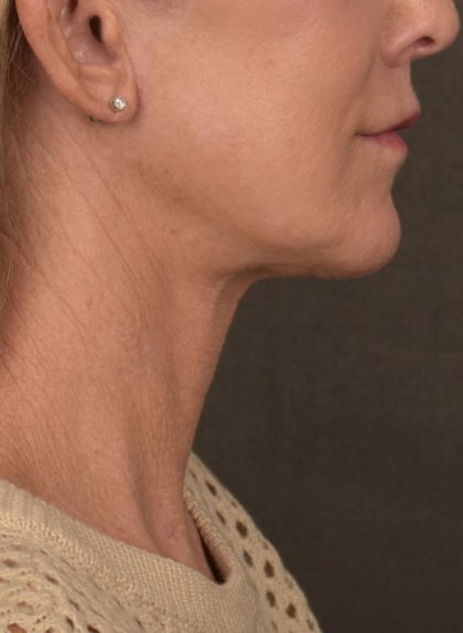 Facelift Before & After Patient #2891