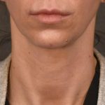 Facelift Before & After Patient #2892