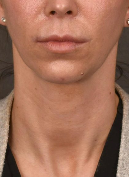 Facelift Before & After Patient #2892