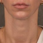 Facelift Before & After Patient #2892