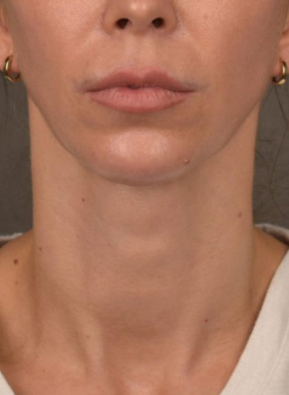 Facelift Before & After Patient #2892