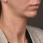 Facelift Before & After Patient #2892