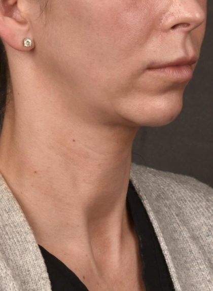 Facelift Before & After Patient #2892