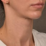 Facelift Before & After Patient #2892