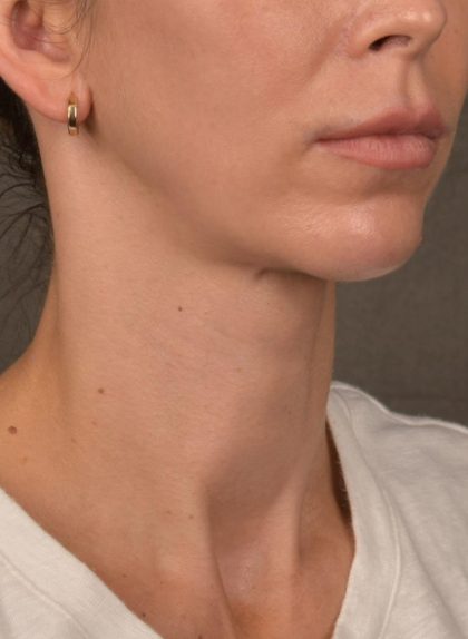 Facelift Before & After Patient #2892