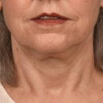 Facelift Before & After Patient #2894