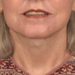 Facelift Before & After Patient #2894