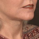 Facelift Before & After Patient #2894