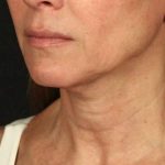 Facelift Before & After Patient #2896