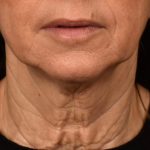 Facelift Before & After Patient #2896