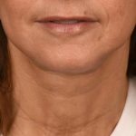 Facelift Before & After Patient #2896