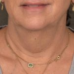 Facelift Before & After Patient #2898