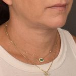 Facelift Before & After Patient #2898