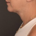 Facelift Before & After Patient #2898