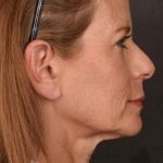 Facelift Before & After Patient #2868